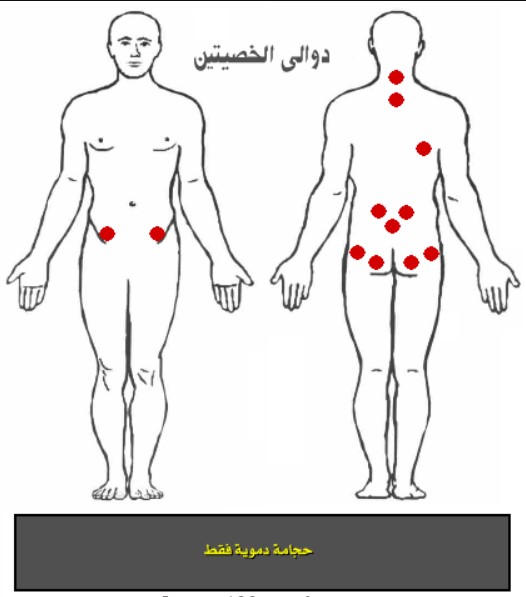 في الخصيتين الدوالي دوالي الخصية